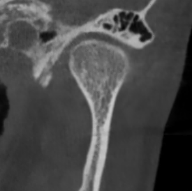 Здоровый сустав: ВНЧС норм 3.png